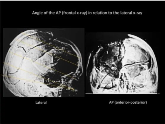 A Review of the JFK Cranial x-Rays and Photographs