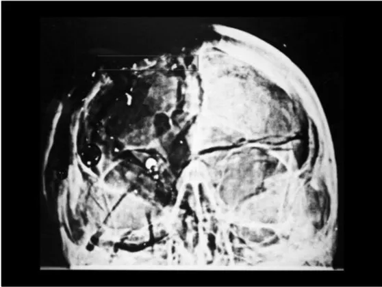 A Review of the JFK Cranial x-Rays and Photographs