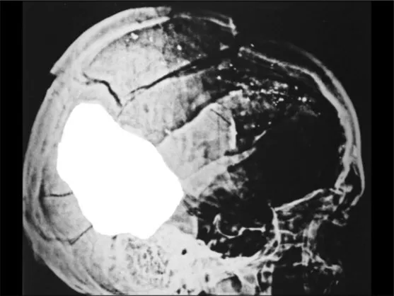 A Review of the JFK Cranial x-Rays and Photographs