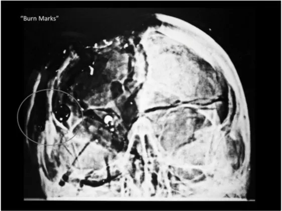 A Review of the JFK Cranial x-Rays and Photographs