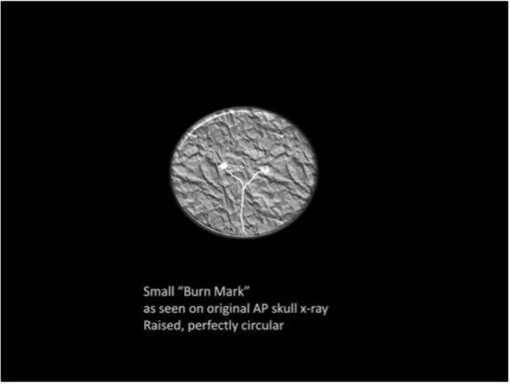 A Review of the JFK Cranial x-Rays and Photographs