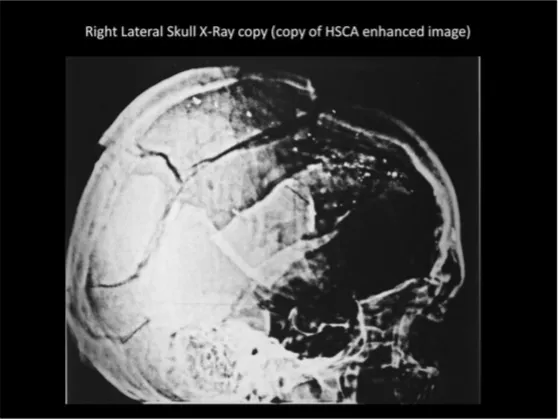 A Review of the JFK Cranial x-Rays and Photographs